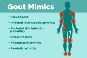 What Can Be Mistaken for Gout?