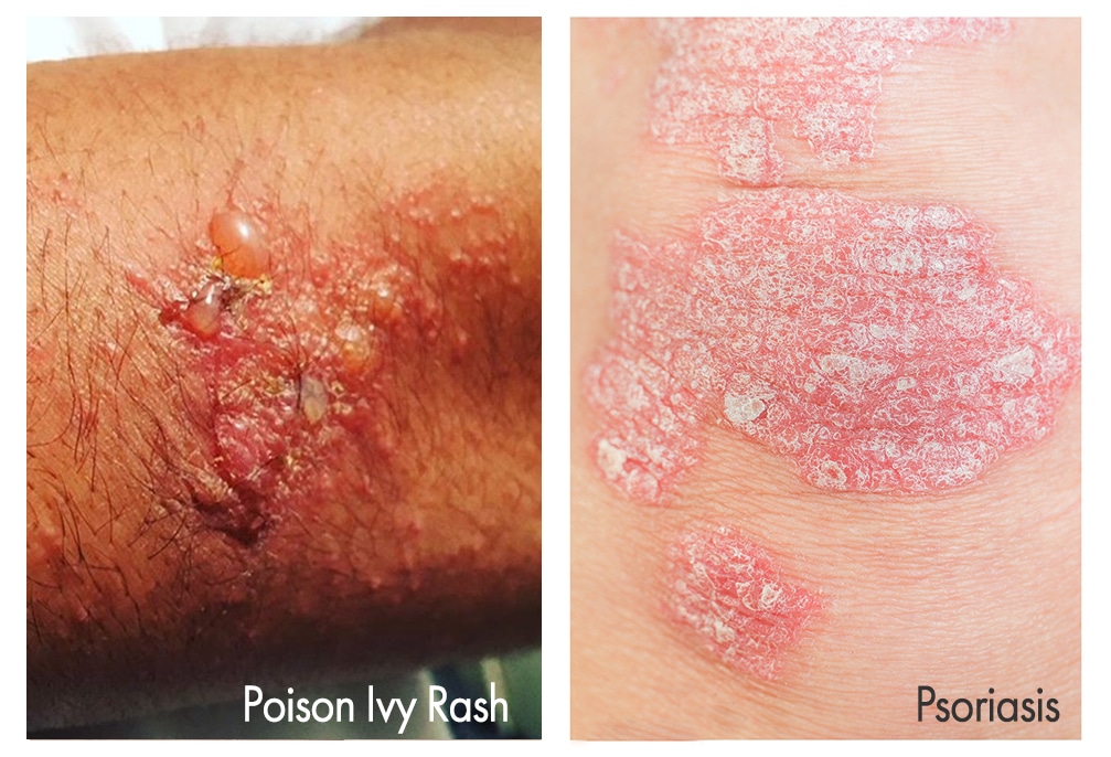 What Can Be Mistaken for Poison Ivy Rash?