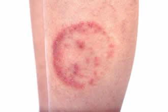 What Can Be Mistaken for Ringworm?