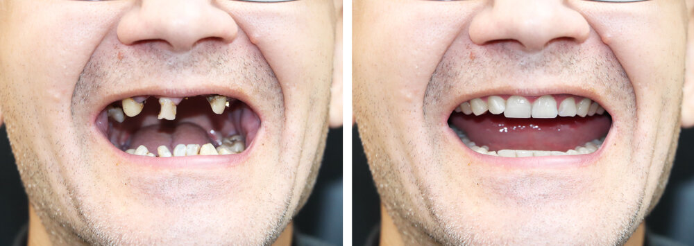 Why Do Dentures Shorten Your Life?